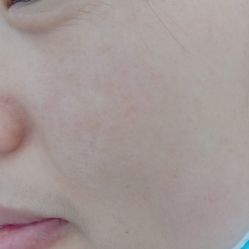 体验后-蕾特恩专业祛痘·皮肤管理