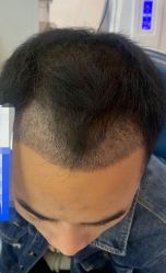 -大麦微针植发全国连锁