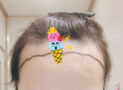 -大麦微针植发全国连锁