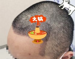 -大麦微针植发全国连锁