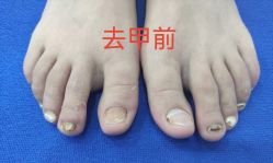 -德哥灰指甲脚气甲沟炎跖疣护理