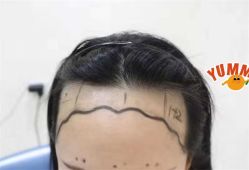-大麦微针植发全国连锁