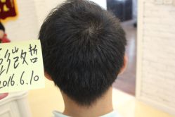 点击看大图 -大麦微针植发丨全国连锁