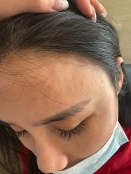 -大麦微针植发丨全国连锁