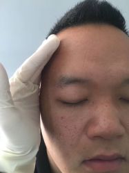 操作前眉毛比较少-杨丹国际美学肌研所