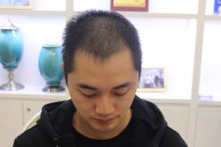 点击看大图 -大麦微针植发丨全国连锁