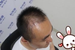 -大麦微针植发丨全国连锁