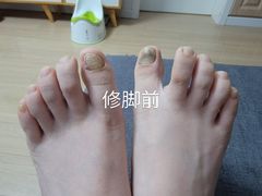 -Andrew指甲专科灰指甲·甲沟炎矫正·3D步态矫形鞋垫定制(浦三路店)