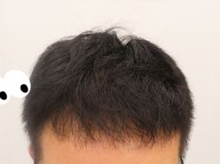 -大麦微针植发全国连锁