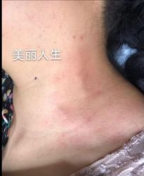 -爱莎扁平疣·汗管瘤·斑痣中心