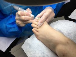 -派恩宜灰指甲鸡眼嵌甲手足癣