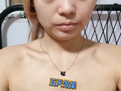 体验后-More摩尔医美の注射线雕光电中心