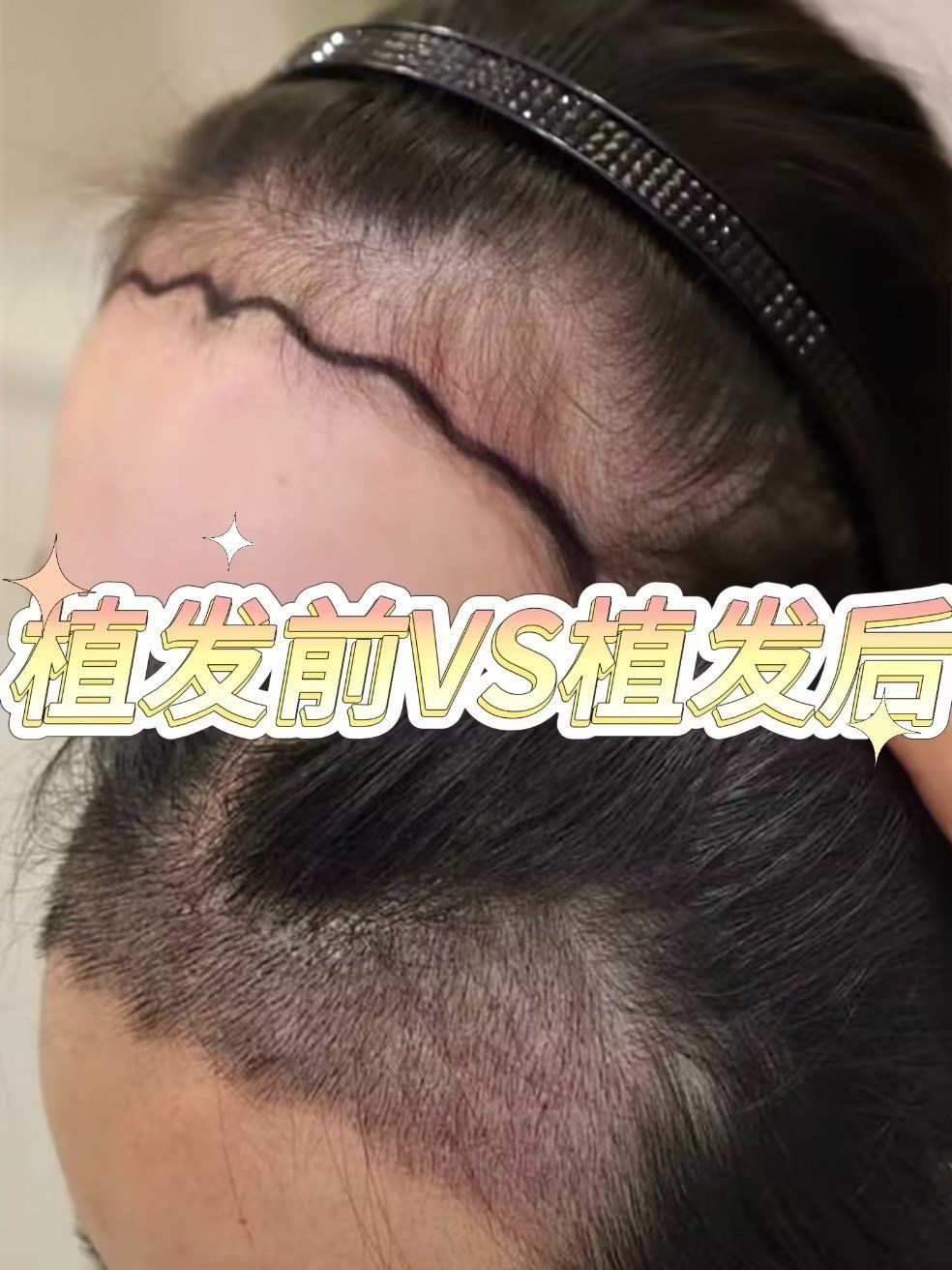 微针植发前后效果分享