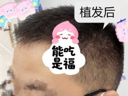 -大麦微针植发全国连锁