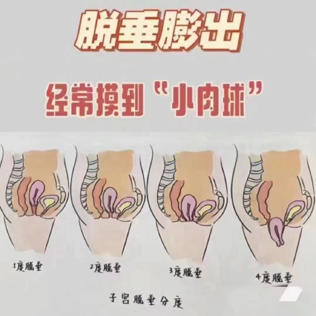 子宫脱垂 真实图片