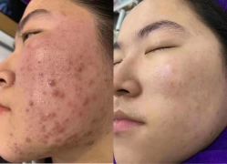点击看大图 -蕾特恩专业祛痘·皮肤管理