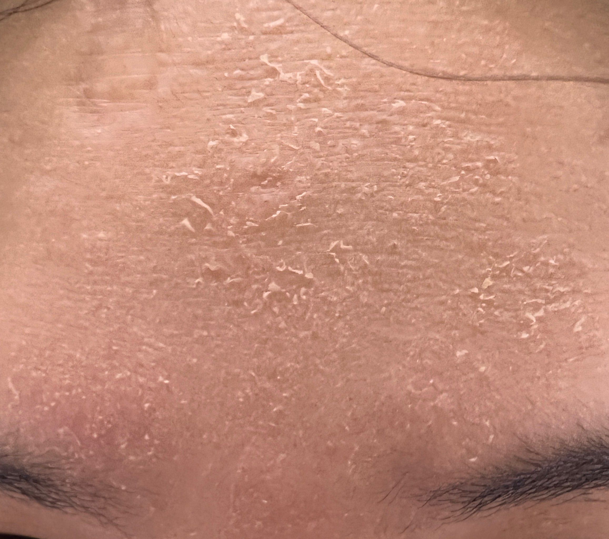 救命🆘 为什么一到秋冬季节皮肤就脱皮