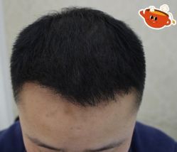 -大麦微针植发丨全国连锁