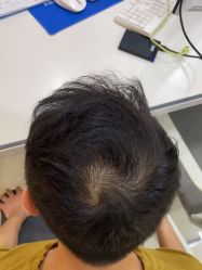 -碧莲盛·不剃发植发
