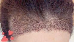 -大麦微针植发丨全国连锁