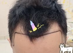 -大麦微针植发全国连锁