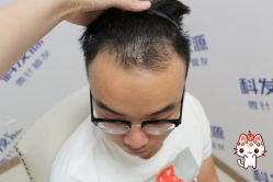 -大麦微针植发丨全国连锁