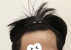 -大麦微针植发全国连锁