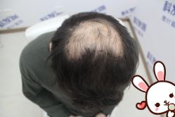 -大麦微针植发丨全国连锁