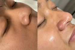 体验前-郡艺医疗美容·微整·眼鼻吸脂