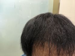 -碧莲盛·不剃发植发