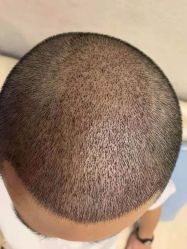 体验前-大麦微针植发全国连锁