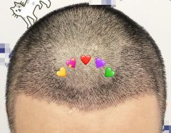 -大麦微针植发全国连锁