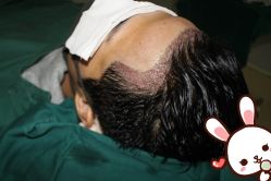 -大麦微针植发丨全国连锁