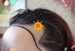 -大麦微针植发全国连锁