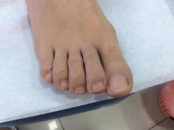 -德哥灰指甲脚气甲沟炎跖疣护理