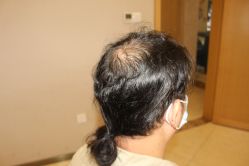 -大麦微针植发丨全国连锁