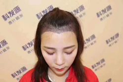 -大麦微针植发丨全国连锁