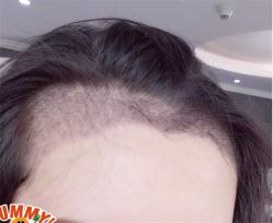 -大麦微针植发全国连锁