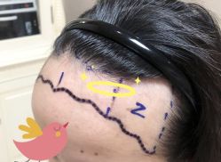 -大麦微针植发全国连锁