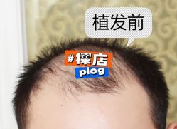 -大麦微针植发全国连锁