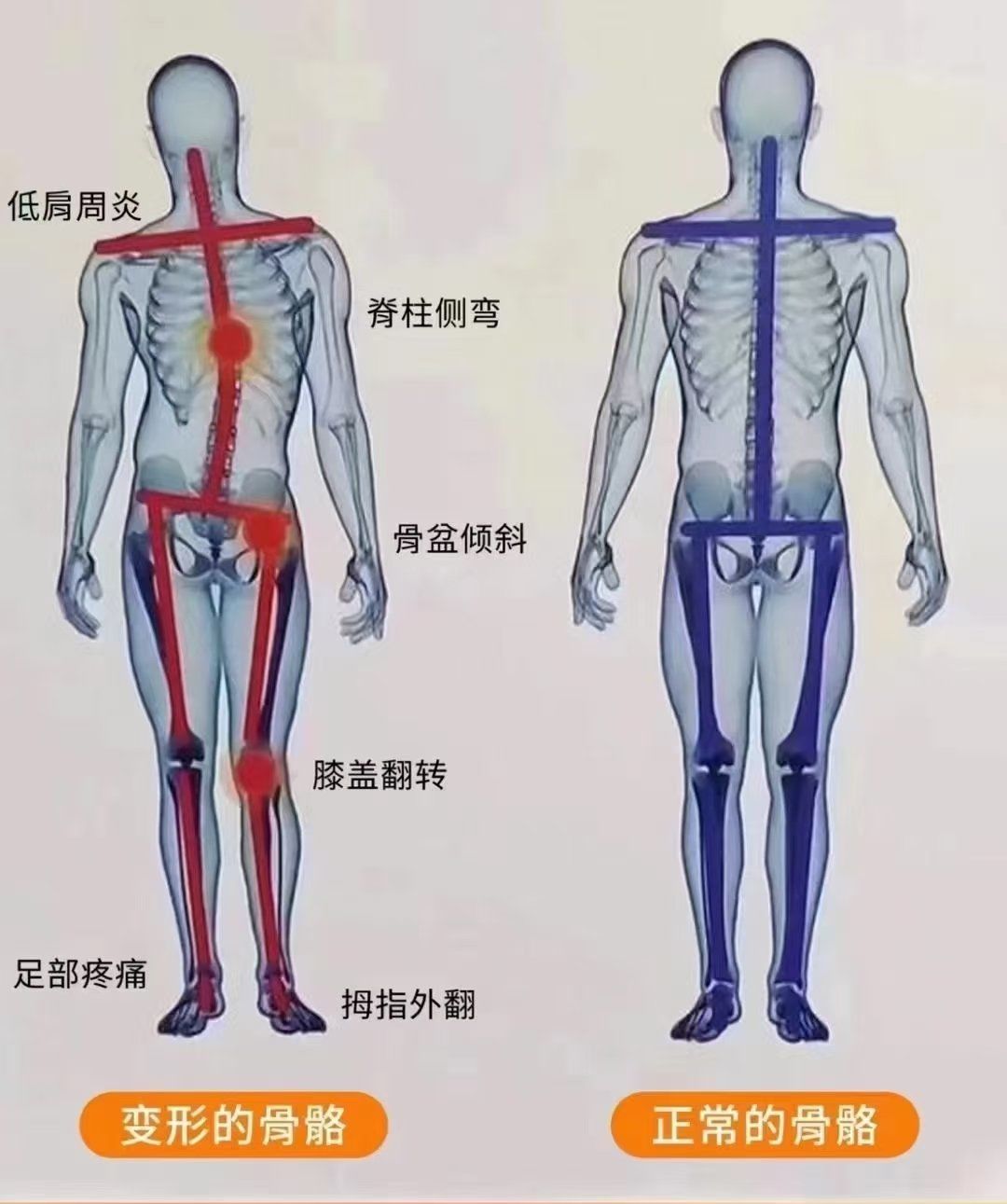 n会引起长短腿,假胯宽,骨盆高低/旋转…
#继而
代偿产生脊柱侧弯