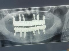 -上海仁爱医院口腔科 · 种植
