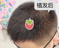 -大麦微针植发全国连锁