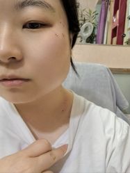 -北京美痣堂古方祛痣斑疣瘊