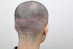 点击看大图 -大麦微针植发丨全国连锁