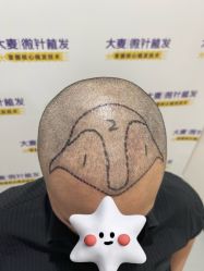 -大麦微针植发全国连锁