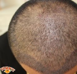 -大麦微针植发丨全国连锁