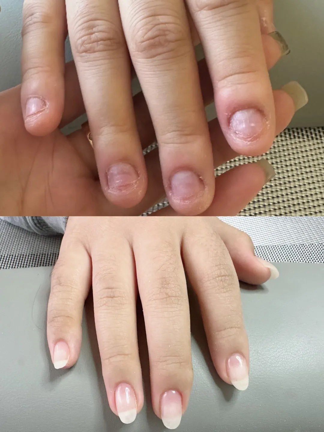 啃咬甲修复后效果甲床完全修复