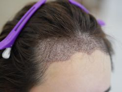 -大麦微针植发丨全国连锁