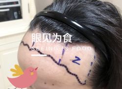 -大麦微针植发全国连锁